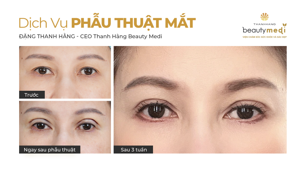 Cắt mí mắt đẹp tự nhiên và hài hòa tại Thanh Hằng Beauty Medi 