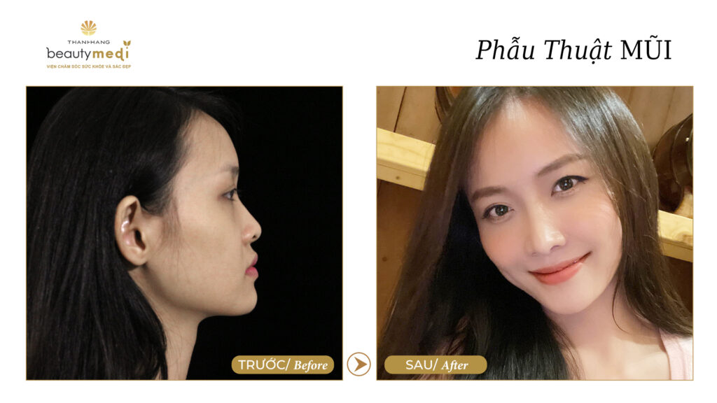 Hình ảnh khách hàng trước và sau khi nâng mũi tại Thanh Hằng Beauty Medi