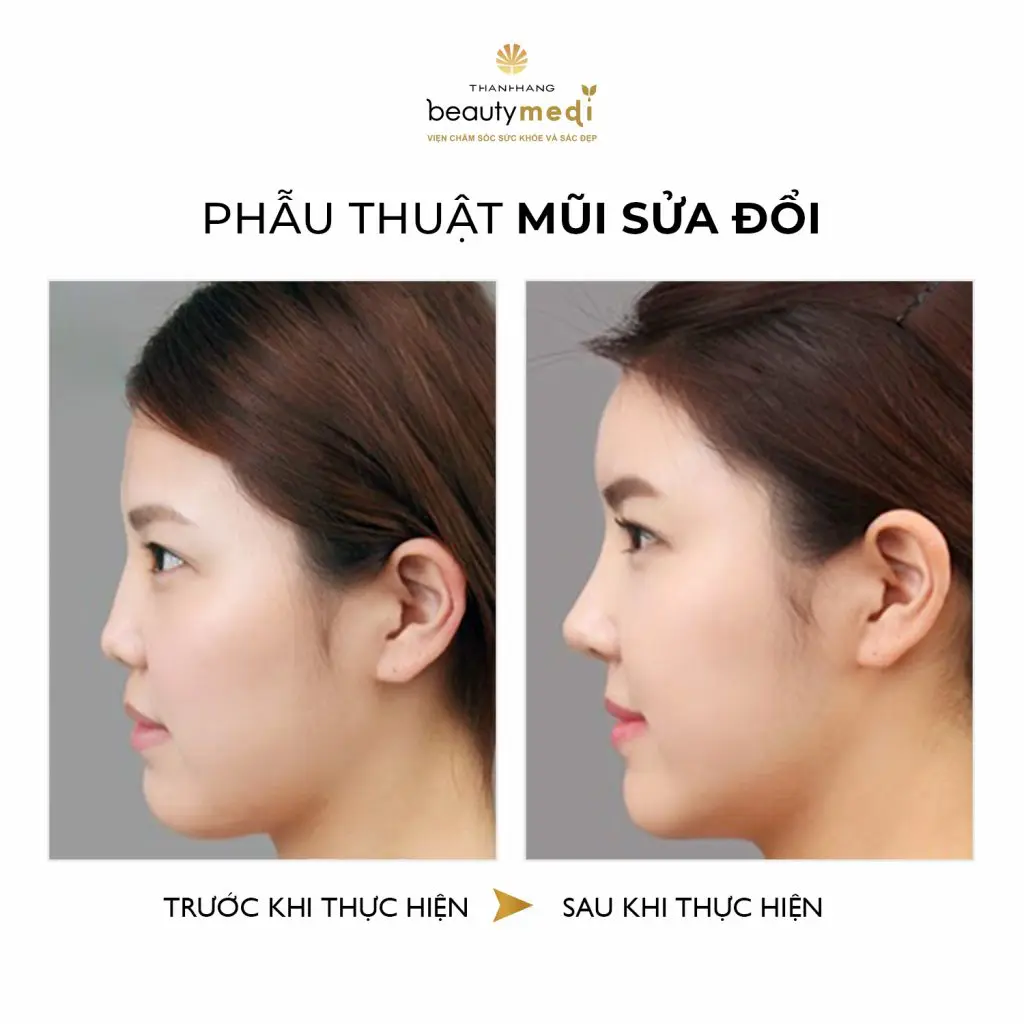 Phương pháp nâng mũi S-line tại Thanh Hằng Beauty Medi