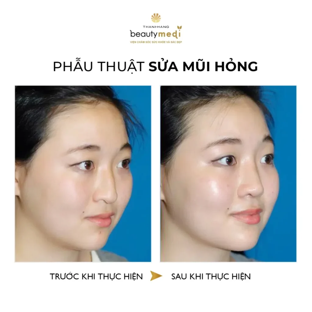 Hình ảnh thực tế của khách hàng phẫu thuật mũi thành công tại Thanh Hằng Beauty Medi