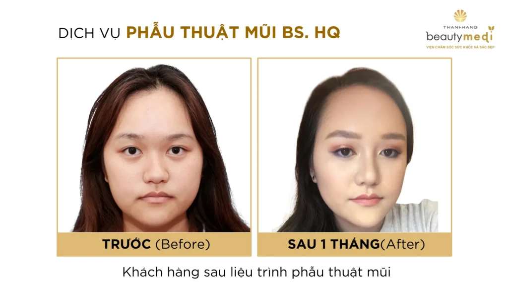 Hình ảnh thực tế của khách hàng phẫu thuật mũi thành công tại Thanh Hằng Beauty Medi