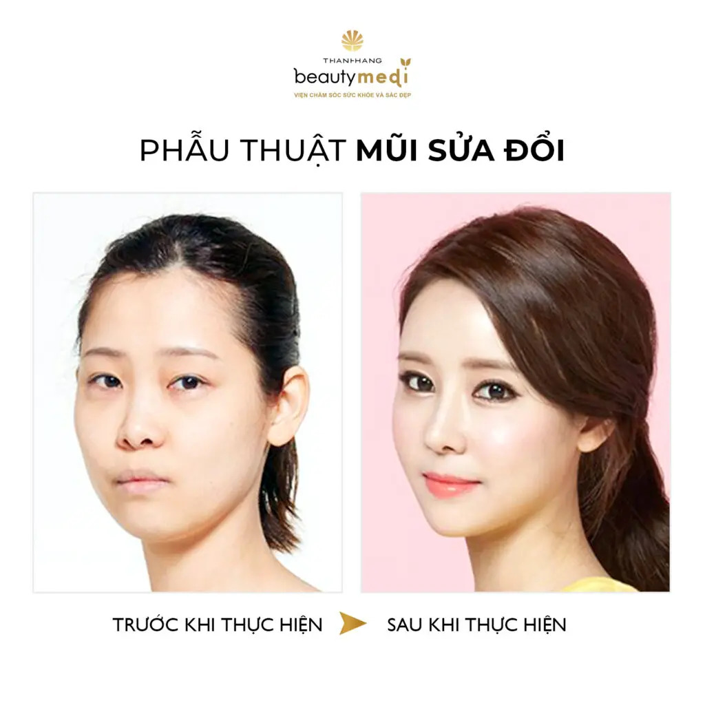 Hình ảnh thực tế của khách hàng phẫu thuật mũi tại Thanh Hằng Beauty Medi